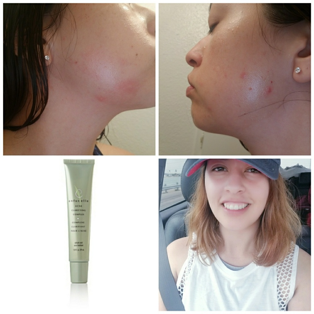 Acne Clarifying Complex